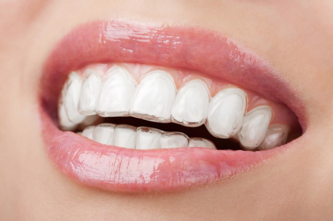 Invisalign unsichtbare Zahnregulierung jetzt mit 300 € Preisermäßigung