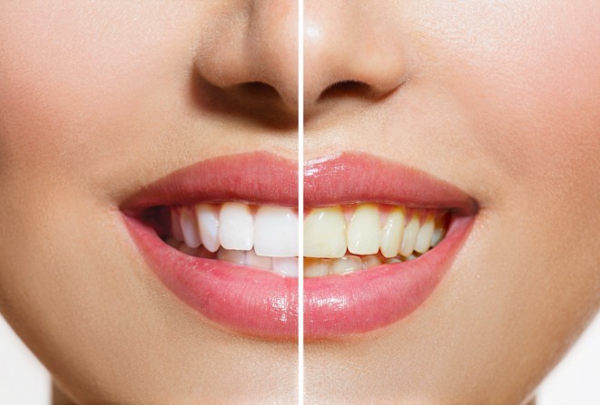 Ragyogóan fehér fogak most 25% kedvezménnyel Biolase Epic X lézeres fogfehérítés AKCIÓ